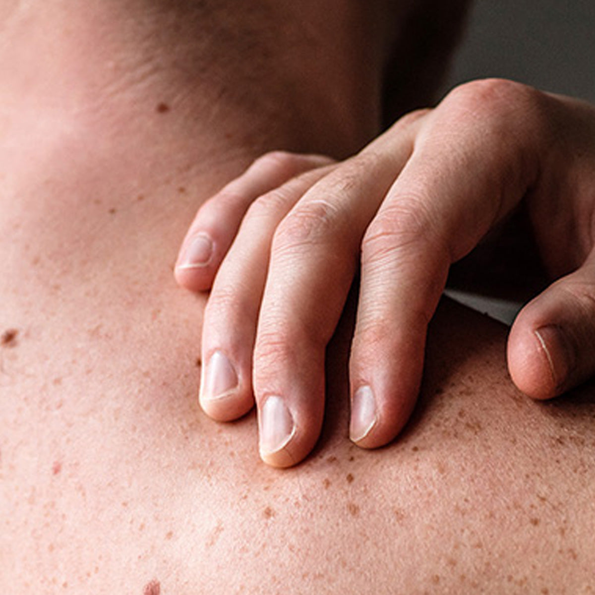 Winship Melonoma TIL Fund